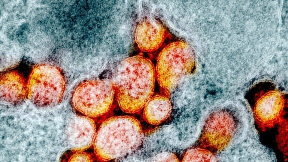 Dieses mit dem Elektronenmikroskop gemachte und nachträglich eingefärbte Bild zeigt den Erreger SARS-CoV-2 (gelb eingefärbt). Das Foto hat das National Institute of Allergy and Infectious Diseases der USA bereits im Januar veröffentlicht.